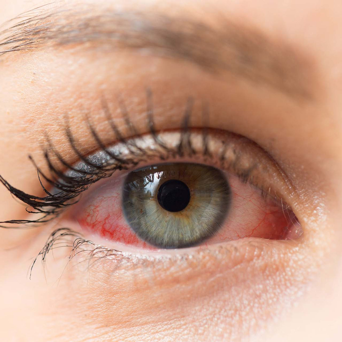 eye-allergies-symptoms-causes-and-treatment-allermi