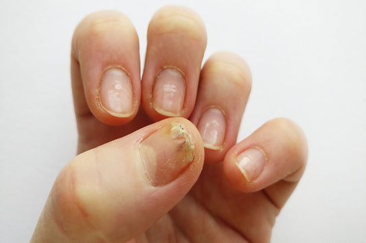 gel nail allergy